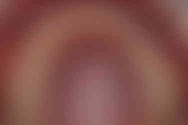 부산매복치아교정