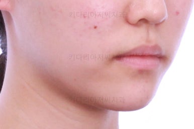 부산비발치교정