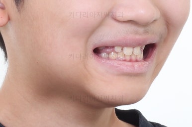 부산어린이돌출입교정