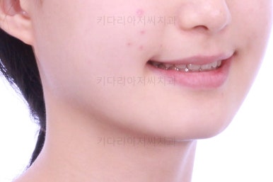 동래구치아교정