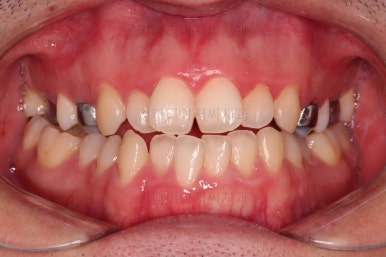 부산긴얼굴긴턱교정