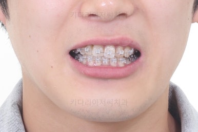 연산동치아교정