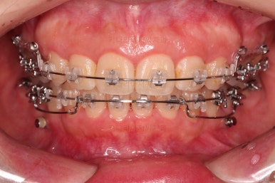 부산무턱교정치과