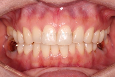 부산치아교정비용