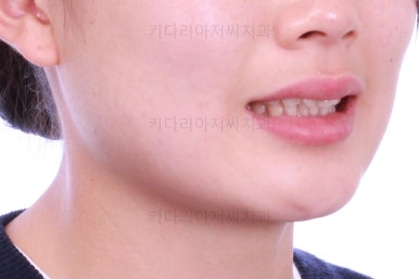 부산앞니부분교정