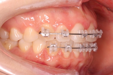 부산나비앞니교정