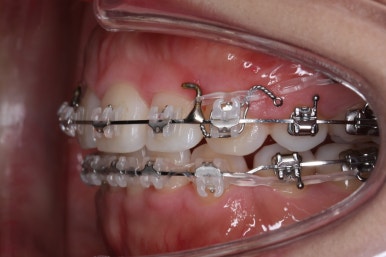 부산연산동교정치과