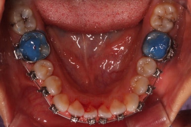 부산구순구개열