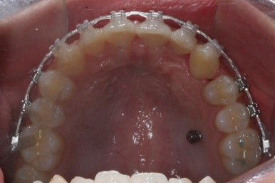 부산매복치아교정