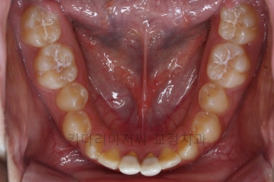 연산동치아교정