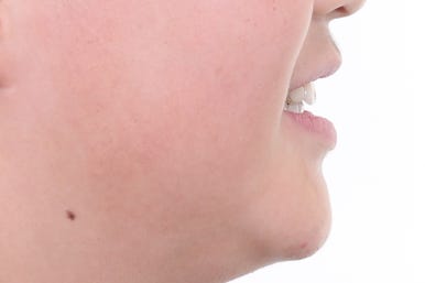 부산비발치교정