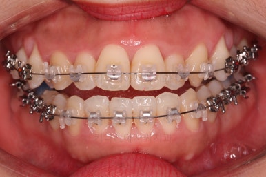 부산비발치교정