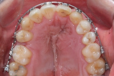 부산구순구개열