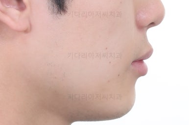 연산동치아교정