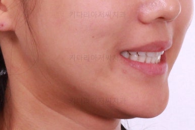 부산치아교정잘하는곳