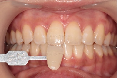 부산돌출입교정