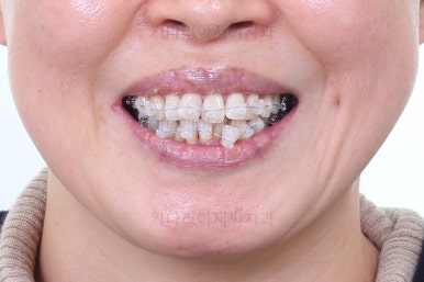 동래임플란트교정