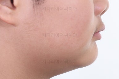 부산성장기교정