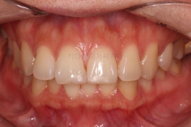 부산연산동교정치과