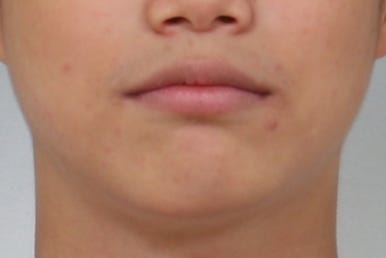 부산왜소치교정