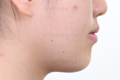 부산비발치교정