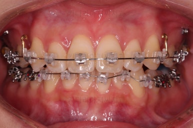 부산돌출입교정