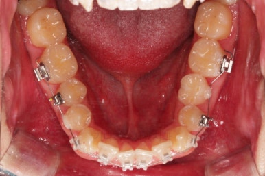 부산주걱턱교정