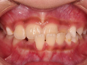 부산어린이교정 키다리아저씨치과에서 시행한 앵글씨 3급 부정교합의 프리올소 치료사례