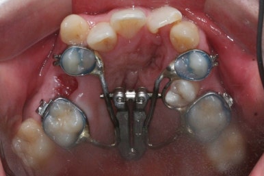 부산구순구개열