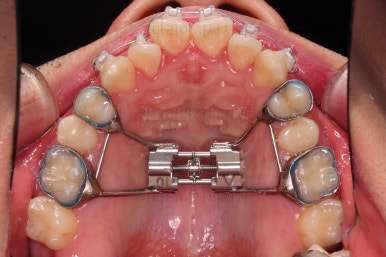 부산긴얼굴긴턱교정