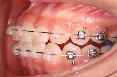 부산치아교정잘하는곳