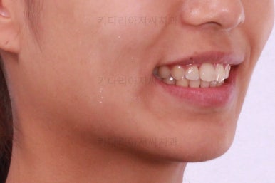 부산연산역치아교정