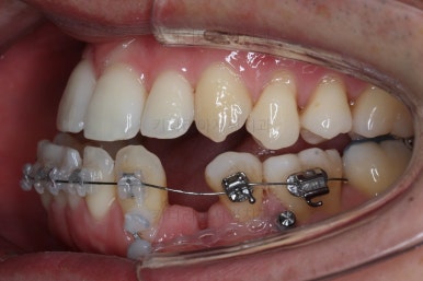 부산비수술교정