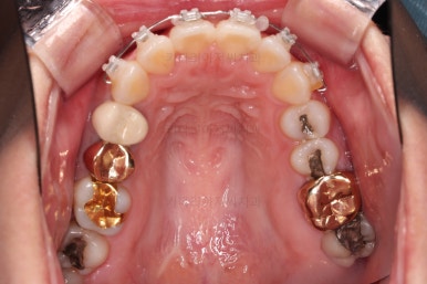 부산부분치아교정