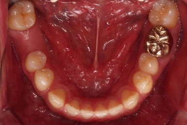 연산동임플란트