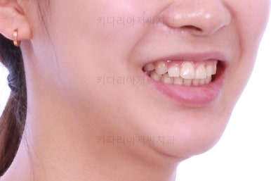 부산안면비대칭