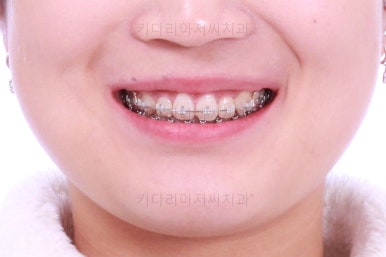 부산치아교정치과