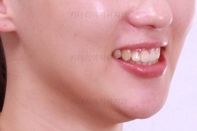 부산비대칭교정