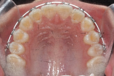 연산동덧니교정