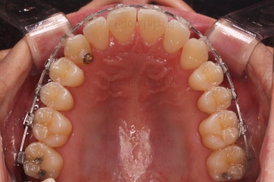 부산비수술교정