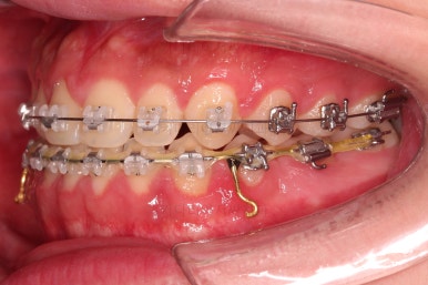 부산주걱턱교정