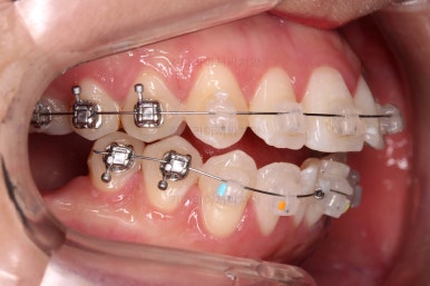 부산사랑니교정