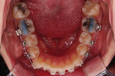 부산비대칭교정