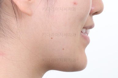 부산비발치교정