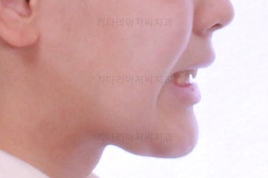 부산연산동치아교정