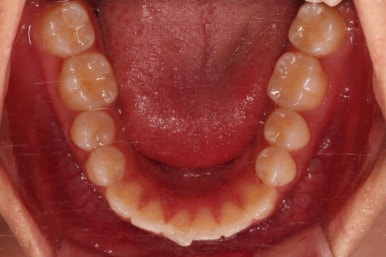 부산비발치교정