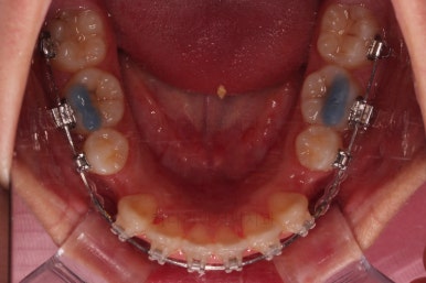 부산클리피씨교정