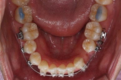 부산비수술교정