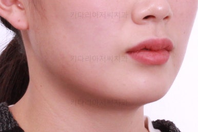 부산앞니부분교정