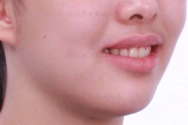 부산투명교정